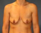 Feel Beautiful - Breast Enhancement San Diego 85 - Before Photo